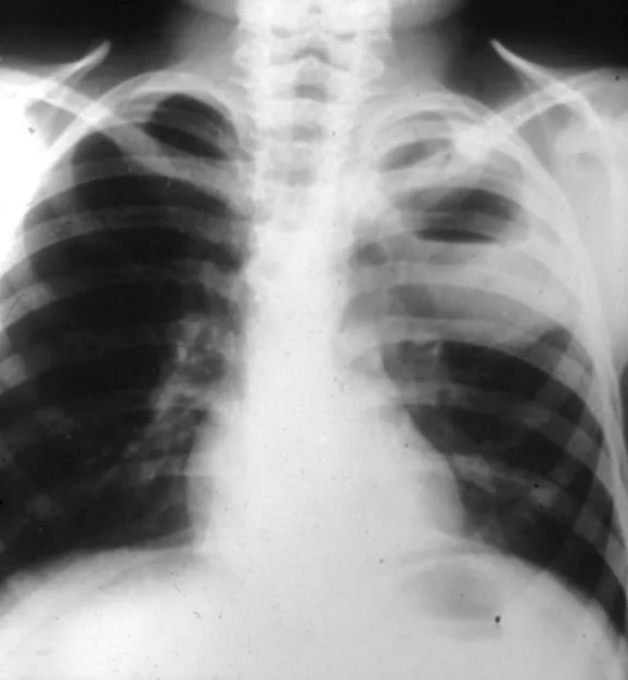 Foreign body inhalation_Table Image 7 Foreign body inhalation_Table Image 7